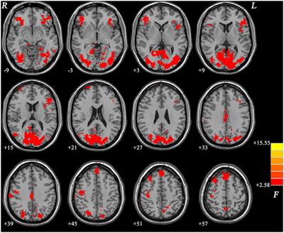 Shared and Distinct Fractional Amplitude of Low-Frequency Fluctuation Patterns in Major Depressive Disorders With and Without Gastrointestinal Symptoms